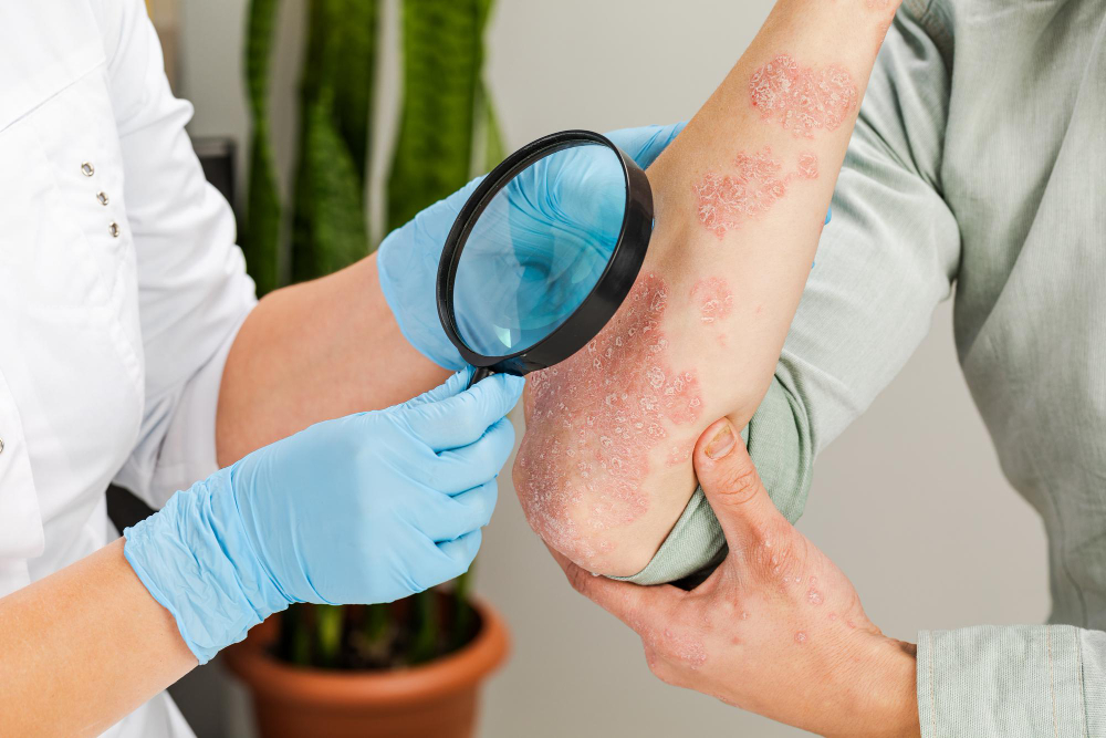 Eczema & Psoriasis