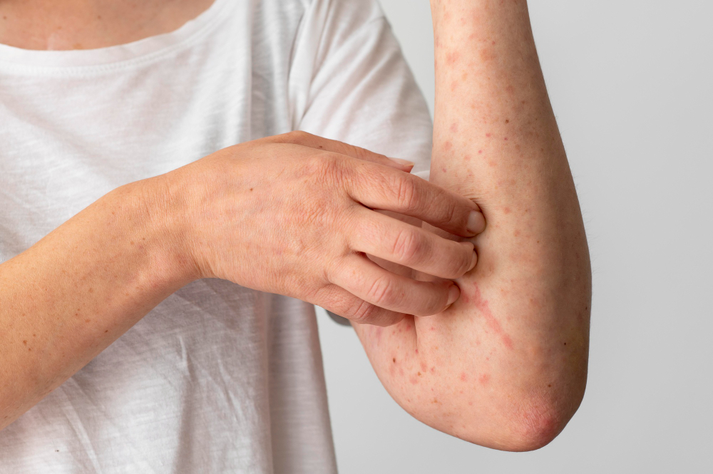 Skin Allergies