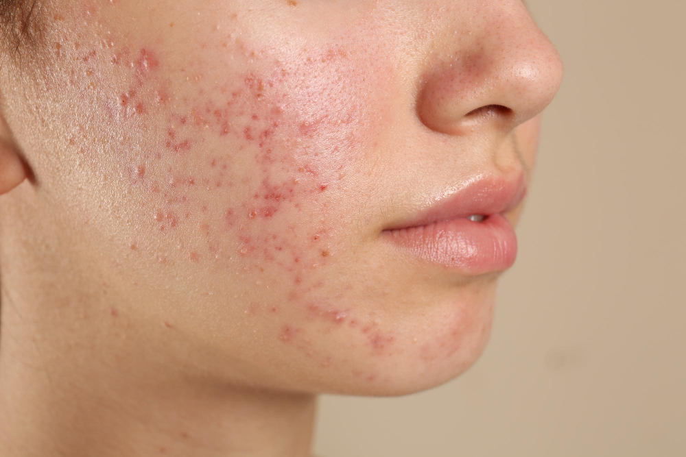 Acne & Acne Scars